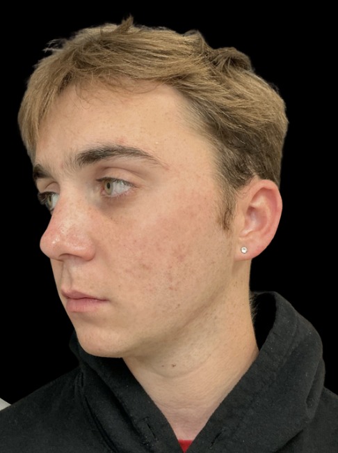 Standard Microneedling after treatment at Juvly Aesthetics