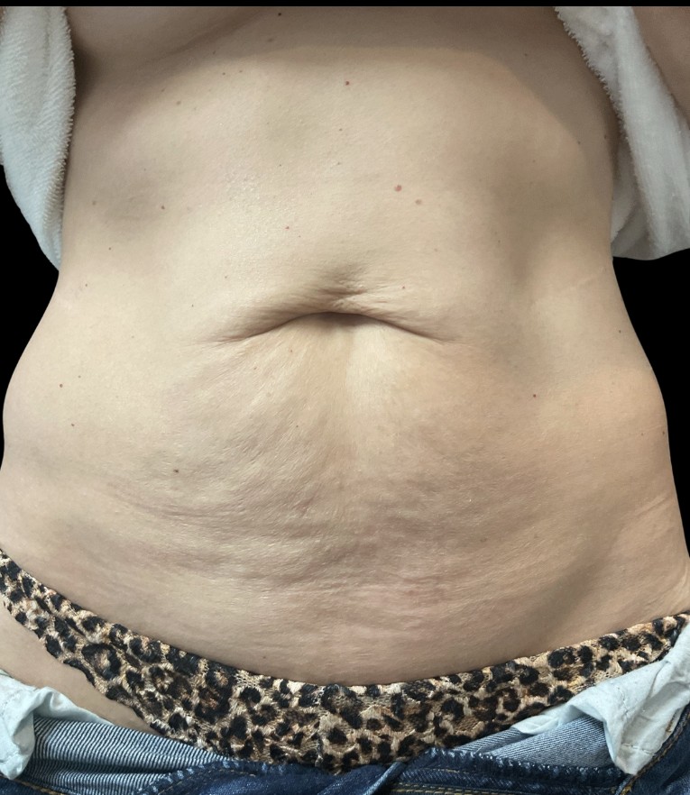 Sylfirm X before treatment at Juvly Aesthetics