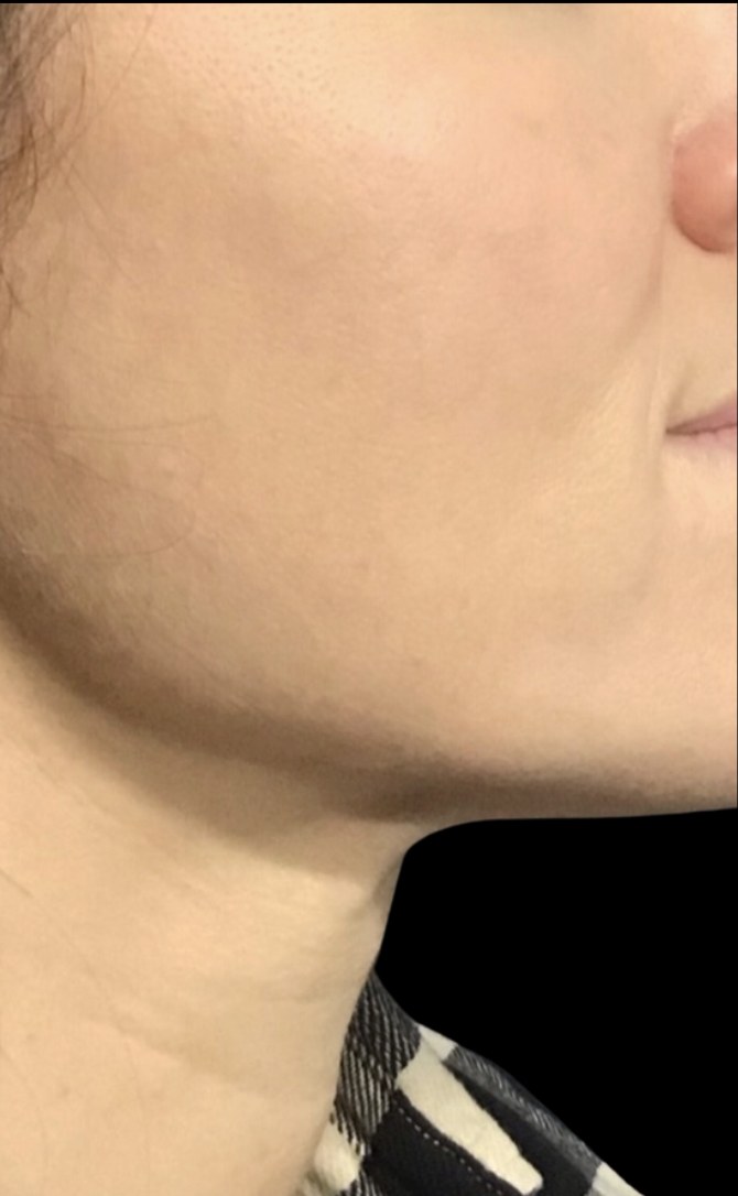 Standard Microneedling after treatment at Juvly Aesthetics