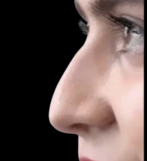 Liquid Nose Job before treatment at Juvly Aesthetics