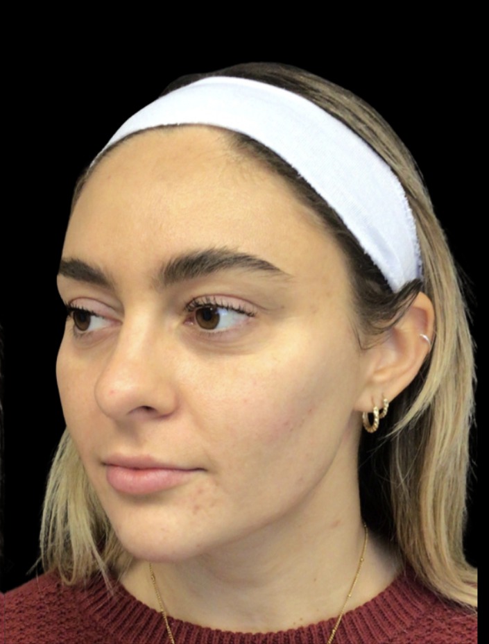 Cheek Filler after treatment at Juvly Aesthetics