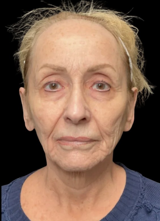 JLyft Non-Surgical Facelift before treatment at Juvly Aesthetics