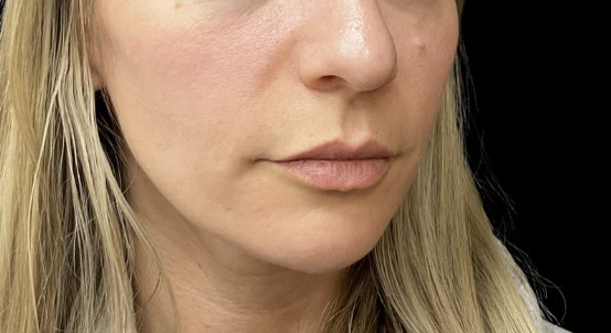 Lip filler before treatment at Juvly Aesthetics