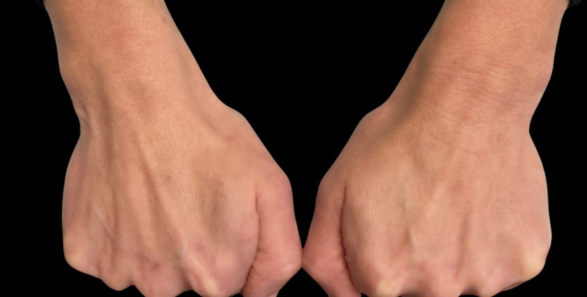 Hand filler before treatment at Juvly Aesthetics