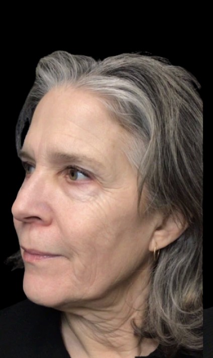 Under-Eye Treatments before treatment at Juvly Aesthetics