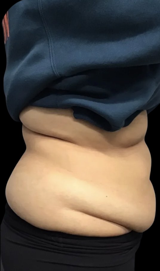 Wellness Rx Membership before treatment at Juvly Aesthetics