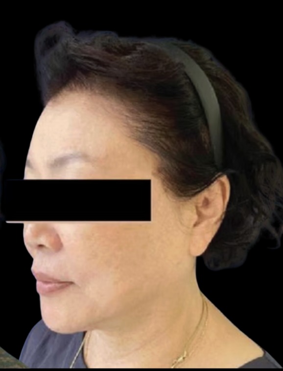 XTherma after treatment at Juvly Aesthetics