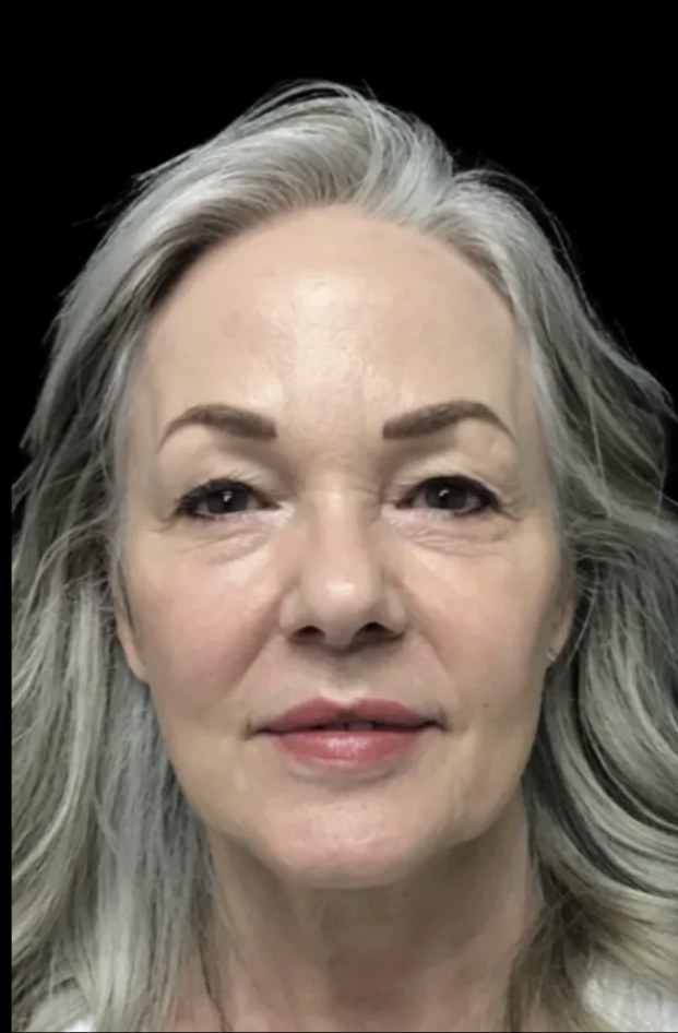 Standard Microneedling before treatment at Juvly Aesthetics