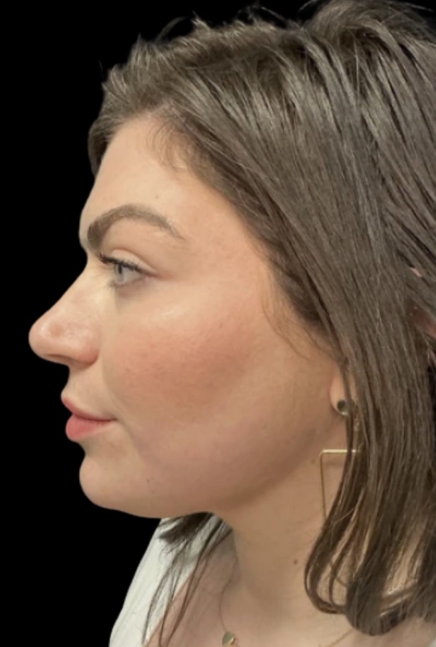 Kybella after treatment at Juvly Aesthetics
