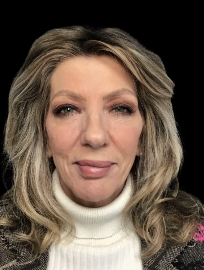 Under-Eye Treatments after treatment at Juvly Aesthetics