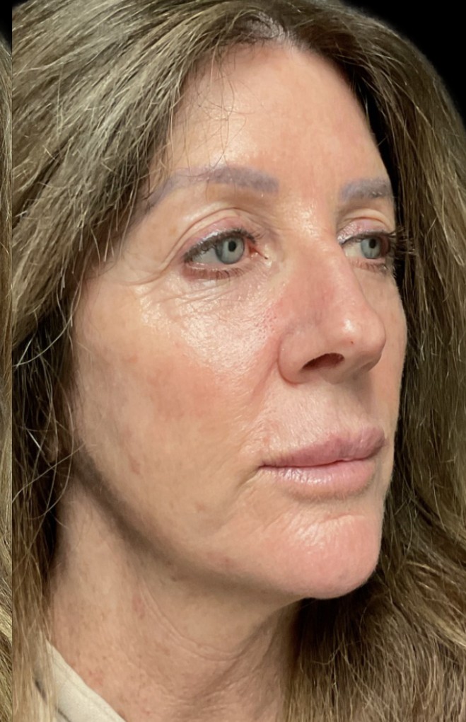 Laser after treatment at Juvly Aesthetics