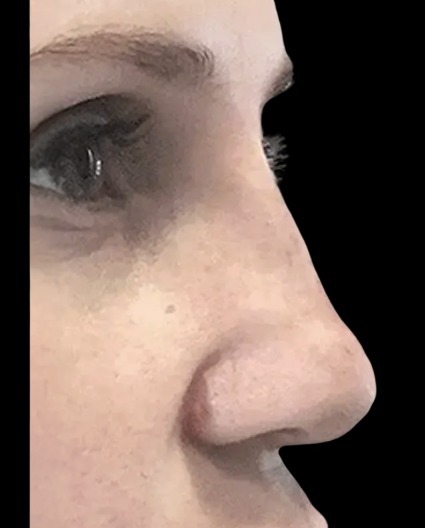 Liquid Nose Job after treatment at Juvly Aesthetics