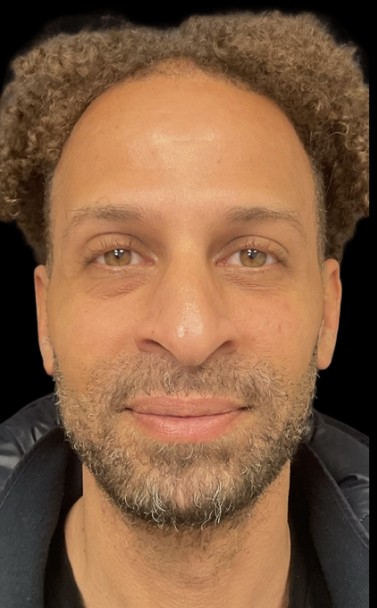 Chemical Peel after treatment at Juvly Aesthetics