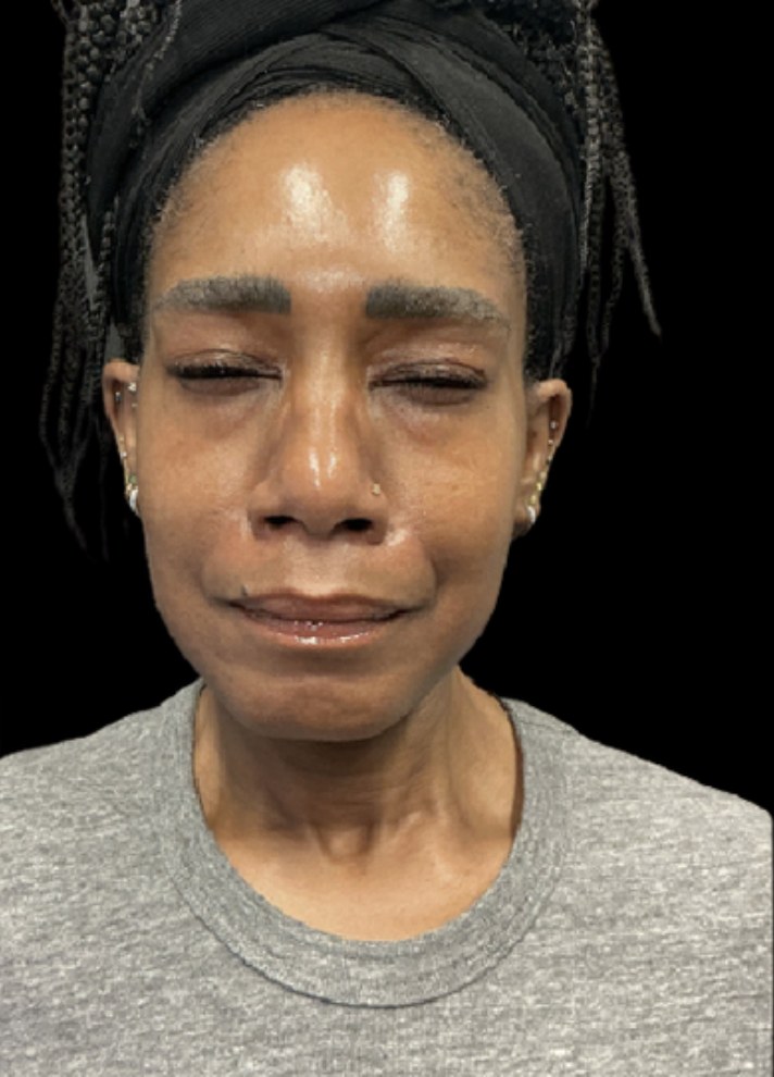 Wrinkle Relaxers after treatment at Juvly Aesthetics