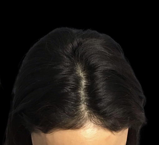 Hair Loss Treatments after treatment at Juvly Aesthetics