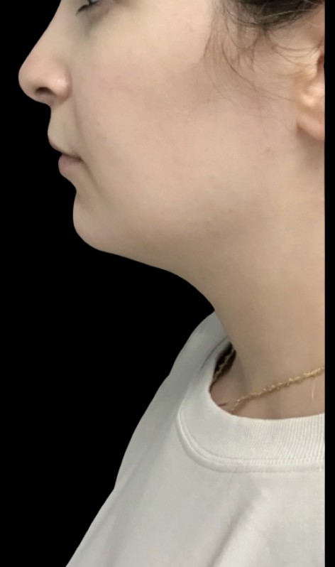 CoolSculpting Submental before treatment at Juvly Aesthetics