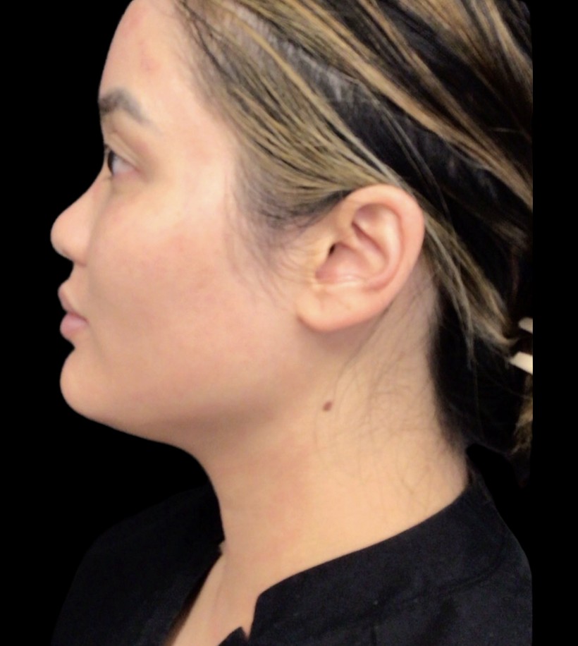 Kybella before treatment at Juvly Aesthetics