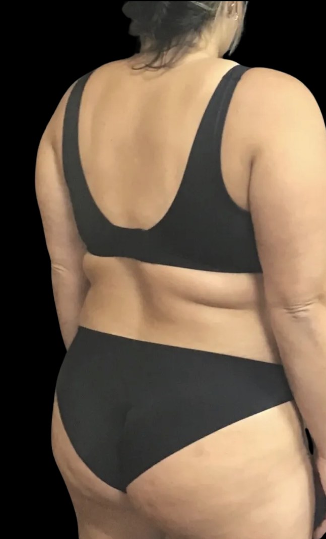 Wellness Rx Membership before treatment at Juvly Aesthetics