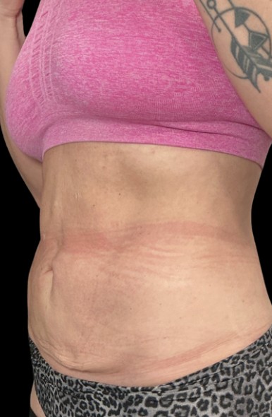 Treatment stacking before treatment at Juvly Aesthetics