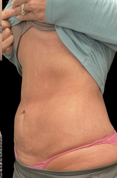 Treatment stacking after treatment at Juvly Aesthetics