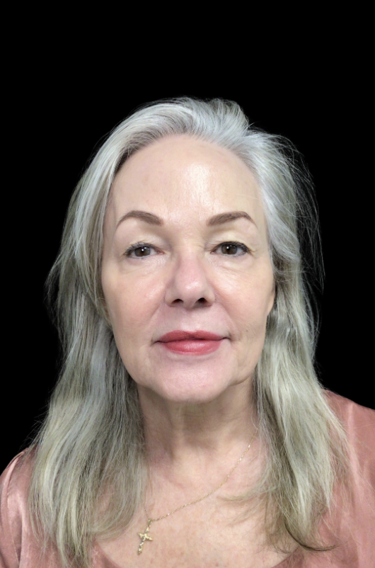 Same client after non-surgical facial rejuvenation at Juvly Aesthetics