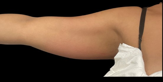 CoolSculpting before treatment at Juvly Aesthetics