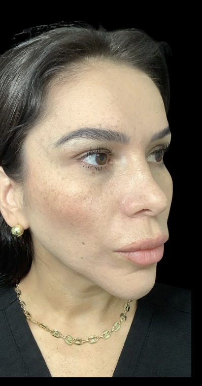 Sylfirm X after treatment at Juvly Aesthetics
