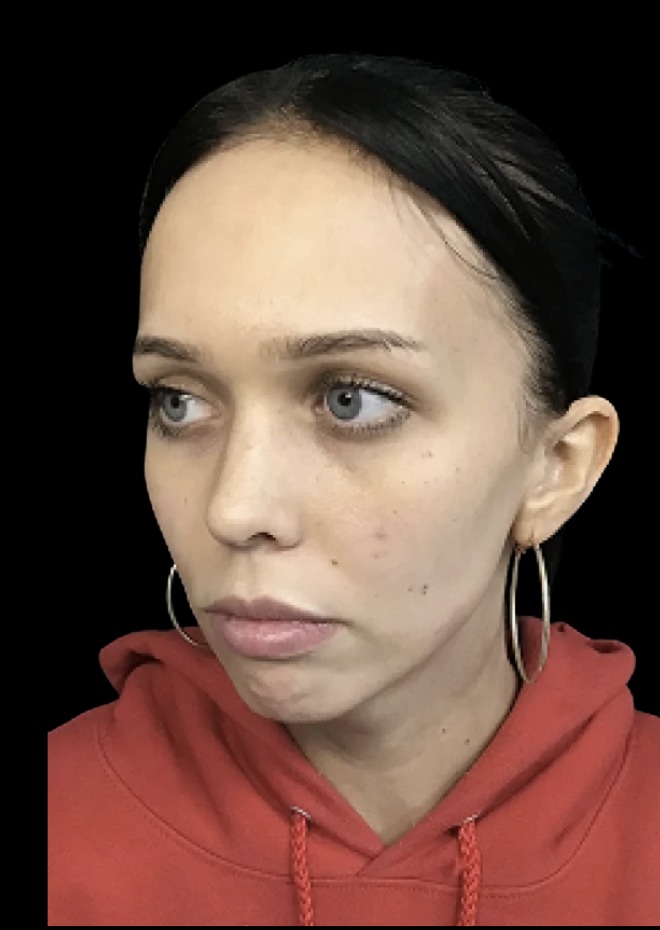 Chin Filler before treatment at Juvly Aesthetics