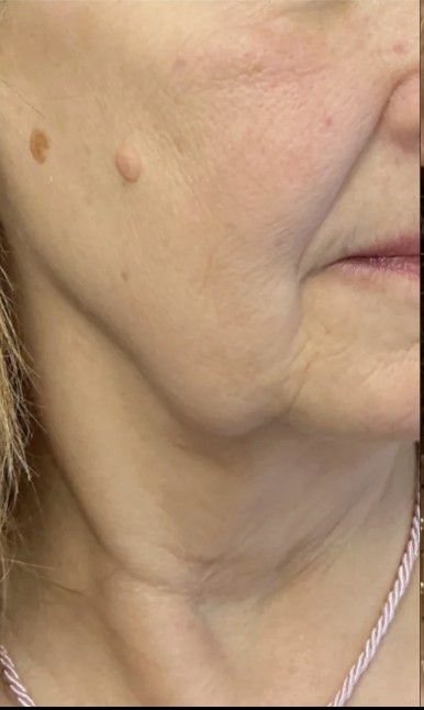Treatment stacking before treatment at Juvly Aesthetics