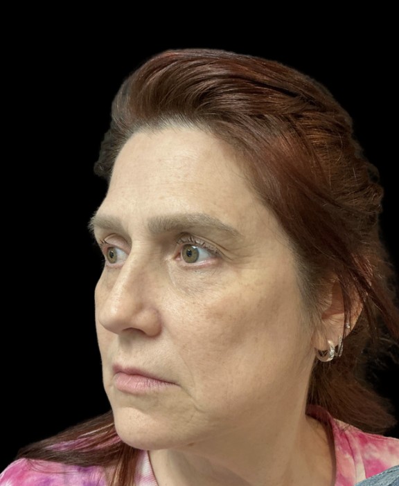 Treatment stacking before treatment at Juvly Aesthetics