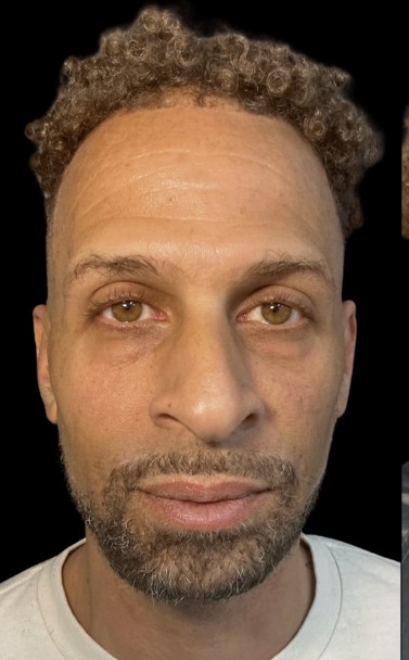 Chemical Peel before treatment at Juvly Aesthetics