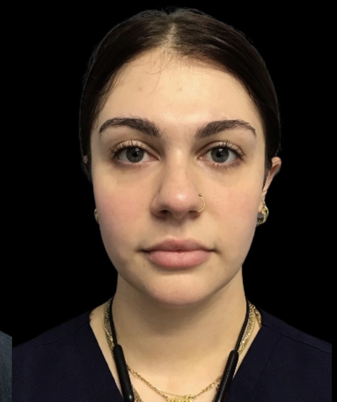 Under-Eye Treatments after treatment at Juvly Aesthetics