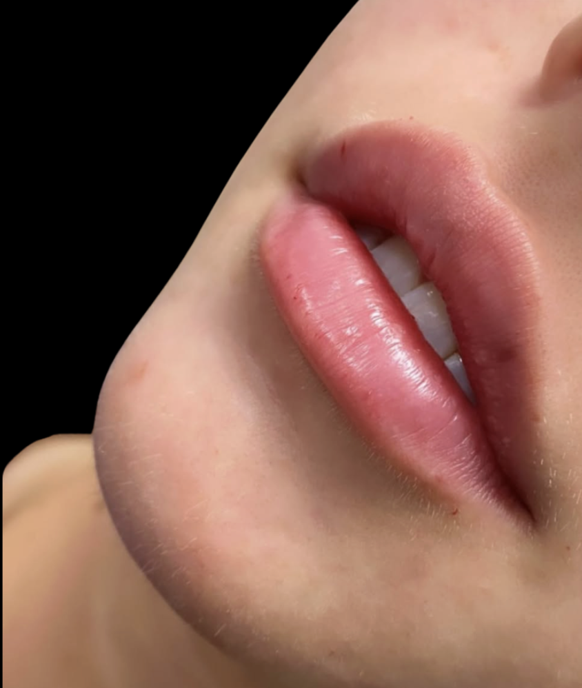 Close-up of softly defined lips after lip filler