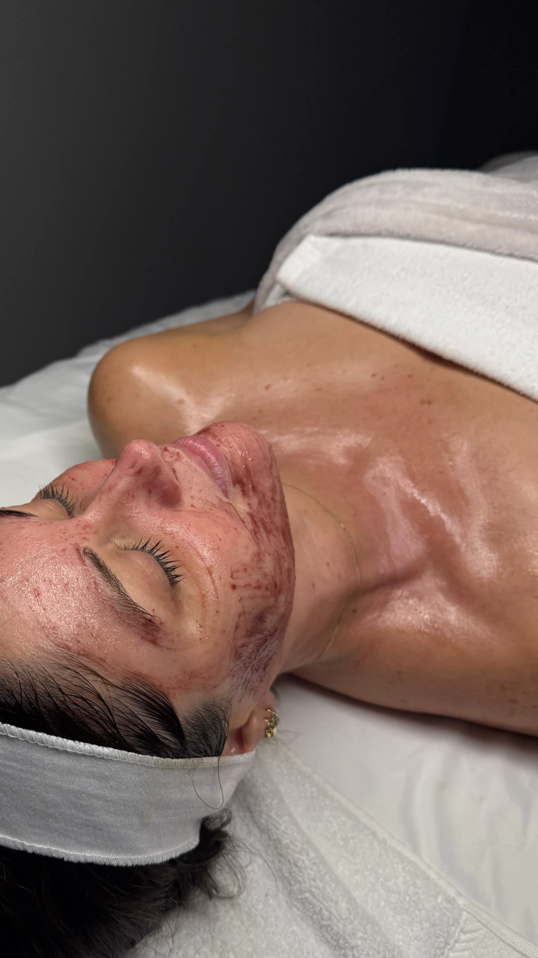 Close-up of skin immediately following a corrective facial treatment