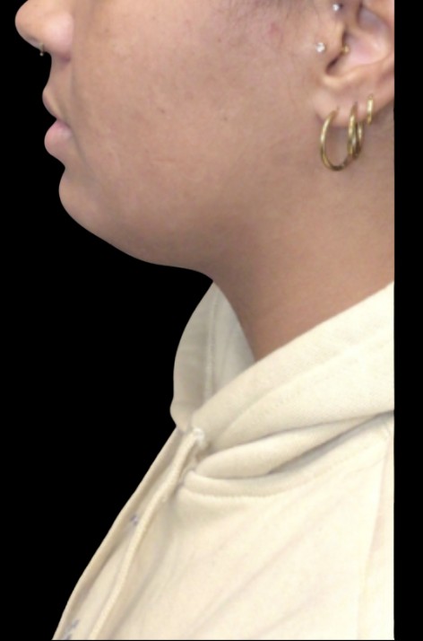 CoolSculpting Submental before treatment at Juvly Aesthetics