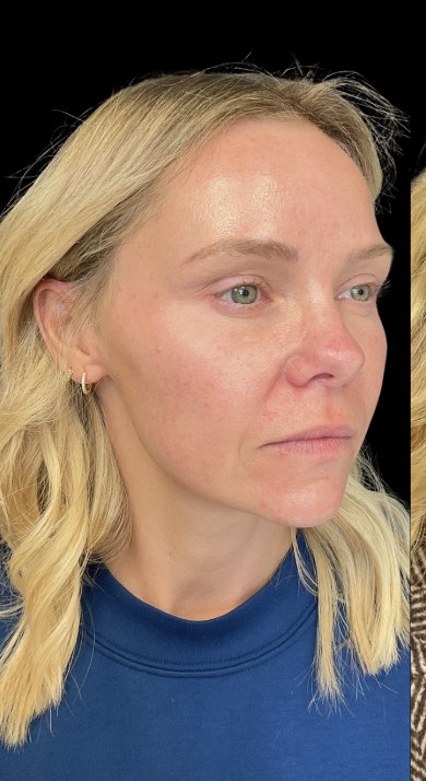 JLyft Non-Surgical Facelift before treatment at Juvly Aesthetics