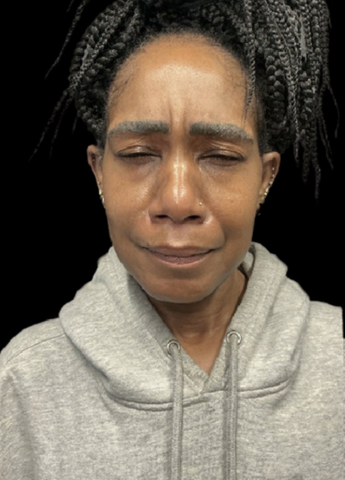 Wrinkle Relaxers before treatment at Juvly Aesthetics