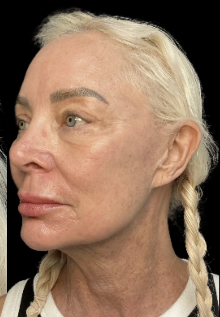 Standard Microneedling after treatment at Juvly Aesthetics