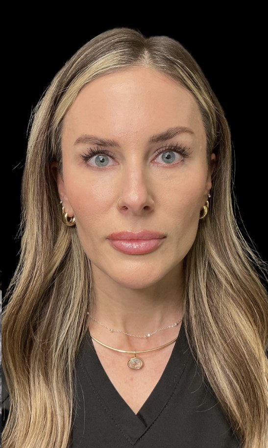 JLyft Non-Surgical Facelift after treatment at Juvly Aesthetics