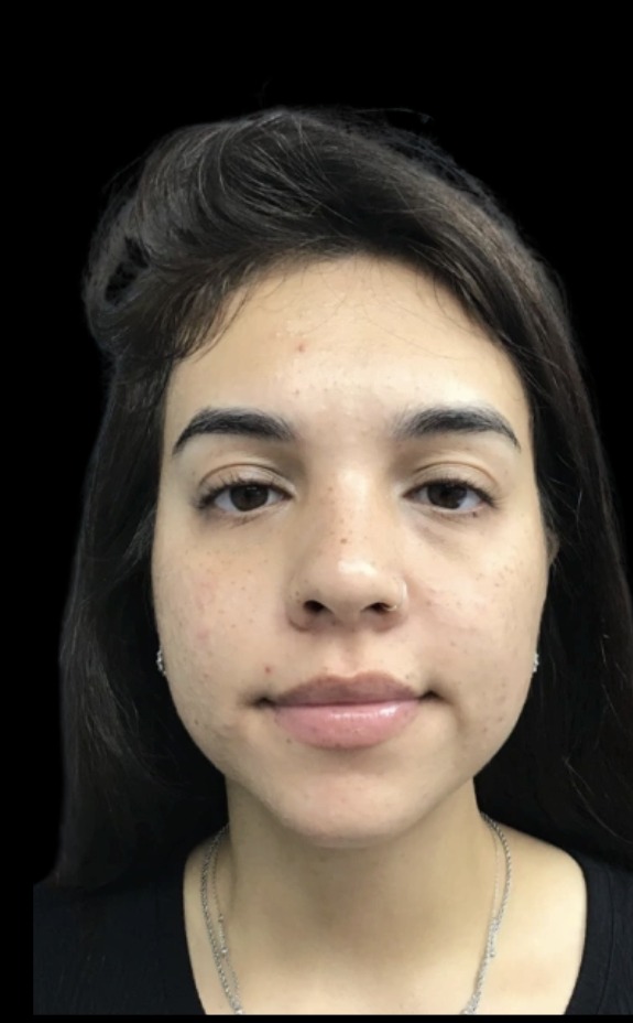 Cheek Filler before treatment at Juvly Aesthetics