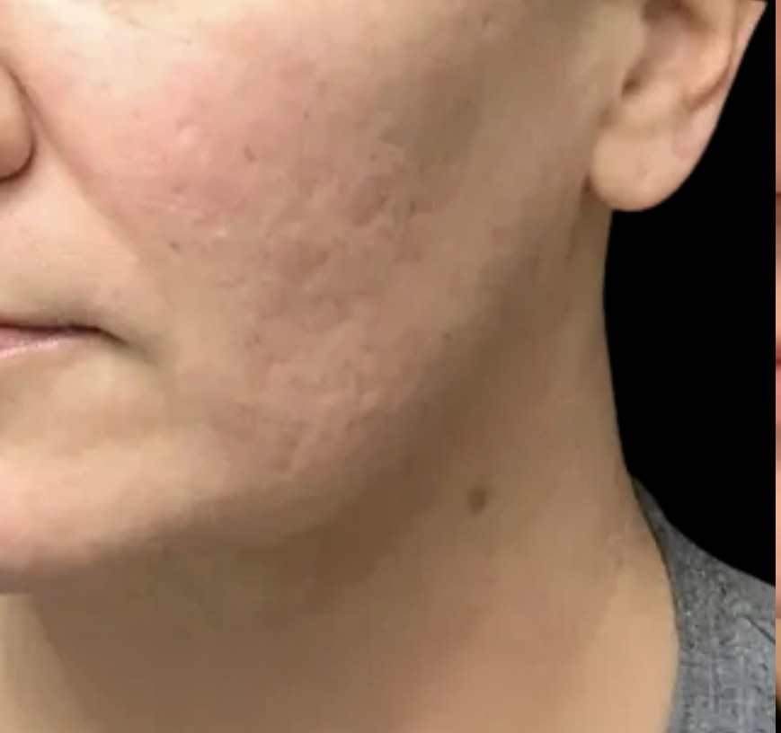 Standard Microneedling before treatment at Juvly Aesthetics