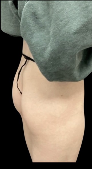 Non-Surgical BBL before treatment at Juvly Aesthetics