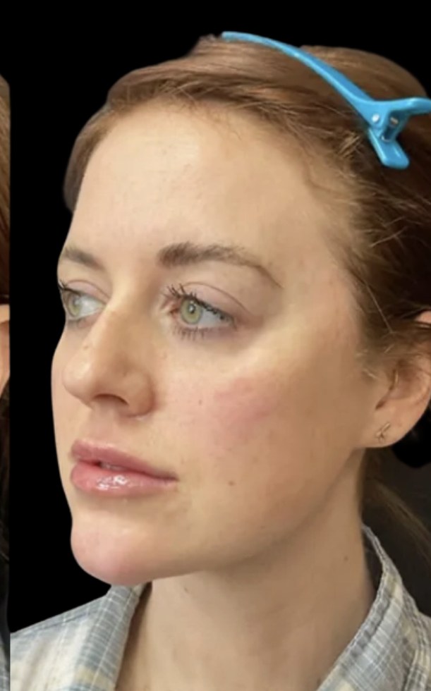 Lip filler after treatment at Juvly Aesthetics