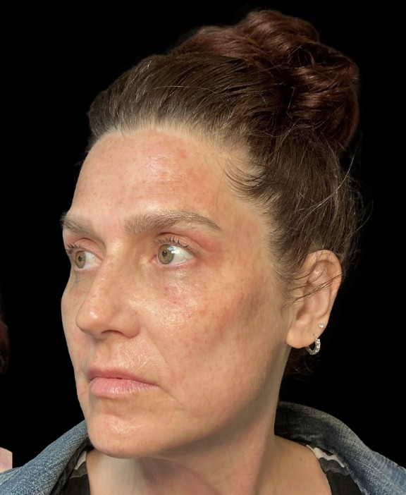 Treatment stacking after treatment at Juvly Aesthetics
