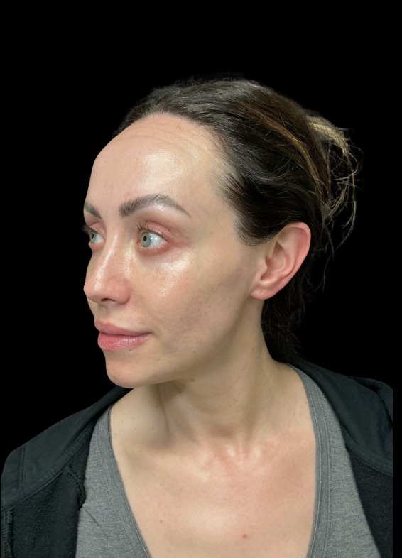 JLyft Non-Surgical Facelift before treatment at Juvly Aesthetics