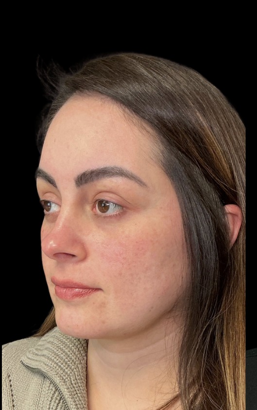 XTherma before treatment at Juvly Aesthetics