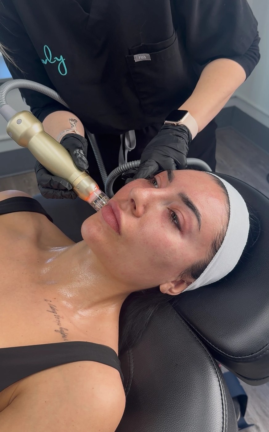 Provider performing Sylfirm X RF microneedling on a client's face