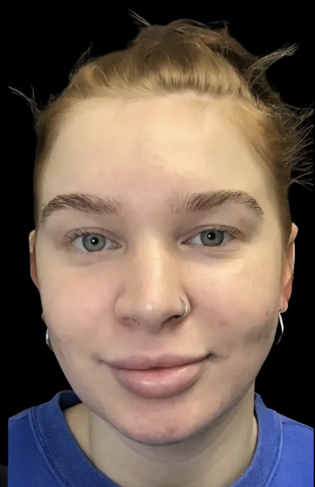 Standard Microneedling after treatment at Juvly Aesthetics