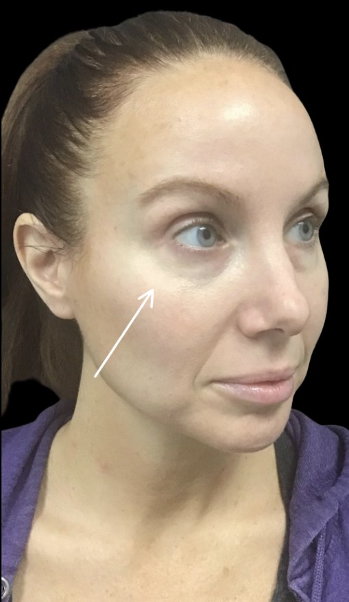 Standard Microneedling before treatment at Juvly Aesthetics