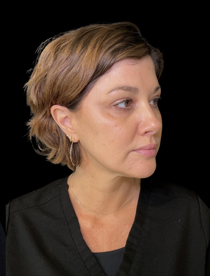 JLyft Non-Surgical Facelift after treatment at Juvly Aesthetics